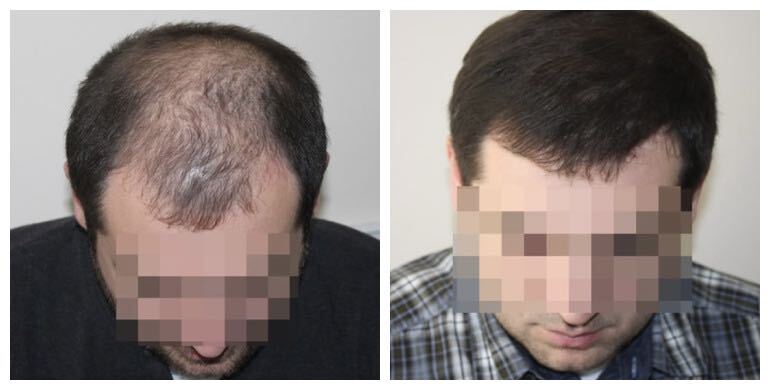 Before and after hair transplant — FUE, 3,000 grafts, male