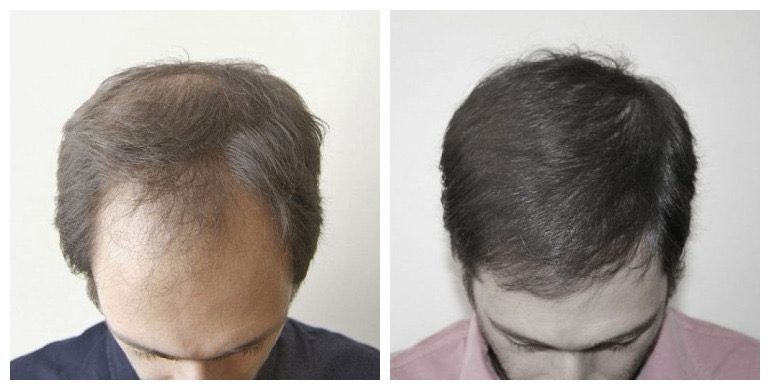Before and after long-hair transplant (FUT) — 3,000 grafts, male
