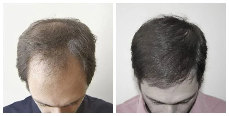 Before and after long-hair transplant (FUT) — 3,000 grafts, male