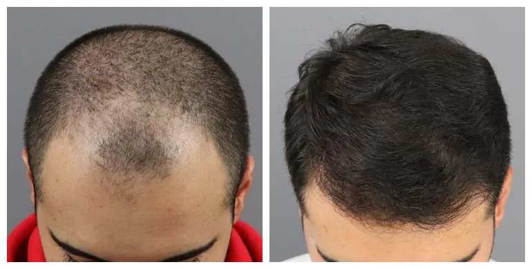Before and after hair transplant — FUE, 2,000 grafts, male