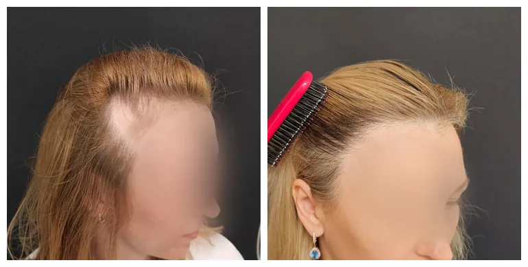 Before and after long-hair transplant (FUE) — 1,800 grafts, female