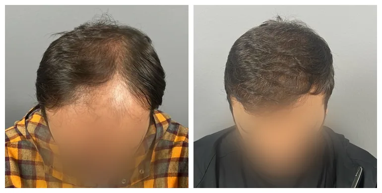 Before and after long-hair transplant (FUT) — 2,500 grafts, male