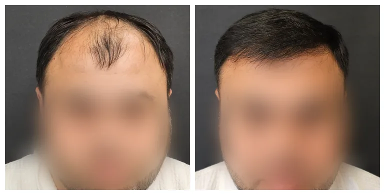 Before and after long-hair transplant (LHT) — 3,000 grafts, male