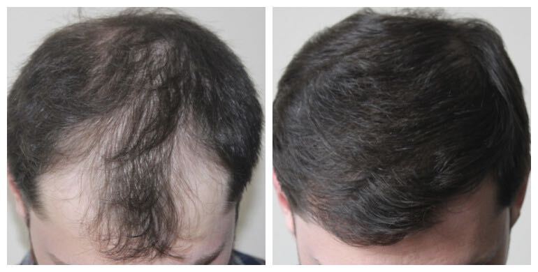 Before and after hair transplant — FUT, 2,000 grafts, male