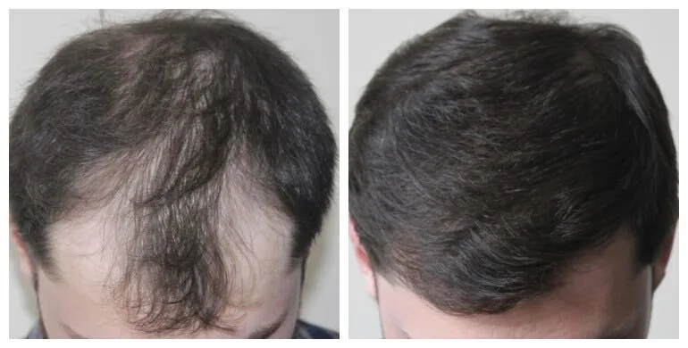 Before and after hair transplant — FUT, 2,000 grafts, male