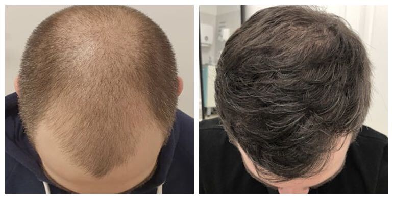 Before and after hair transplant — FUE, 2,500 grafts, male