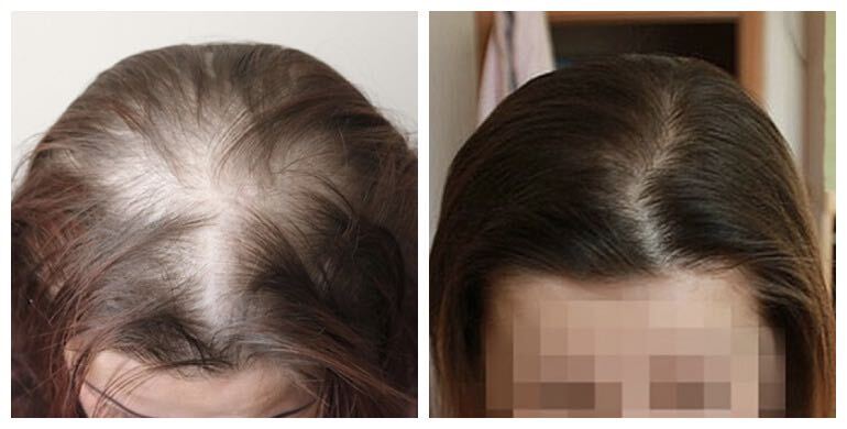 Before and after hair transplant — FUT, 2,000 grafts, female