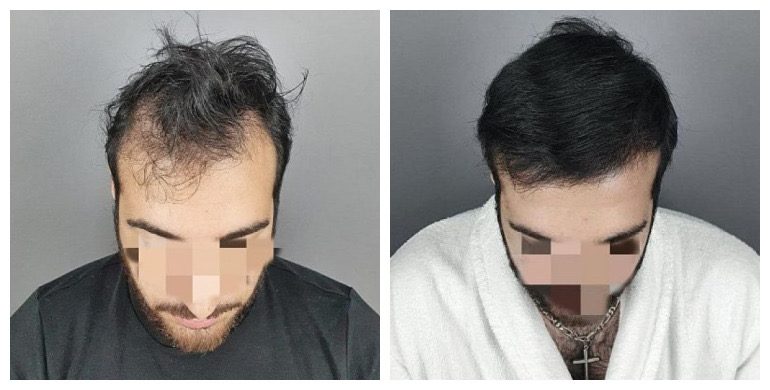 Before and after long-hair transplant (FUT) — 2,000 grafts, male