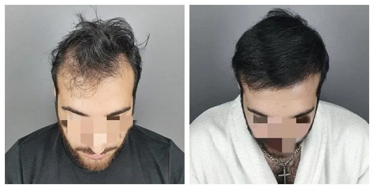 Before and after long-hair transplant (FUT) — 2,000 grafts, male