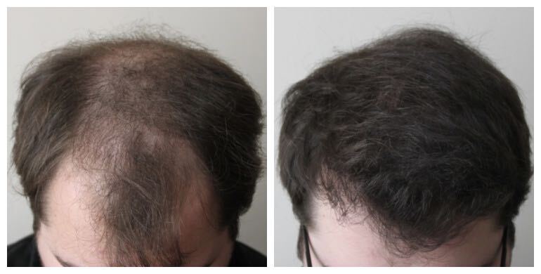 Before and after long-hair transplant (LHT) — 3,000 grafts, male