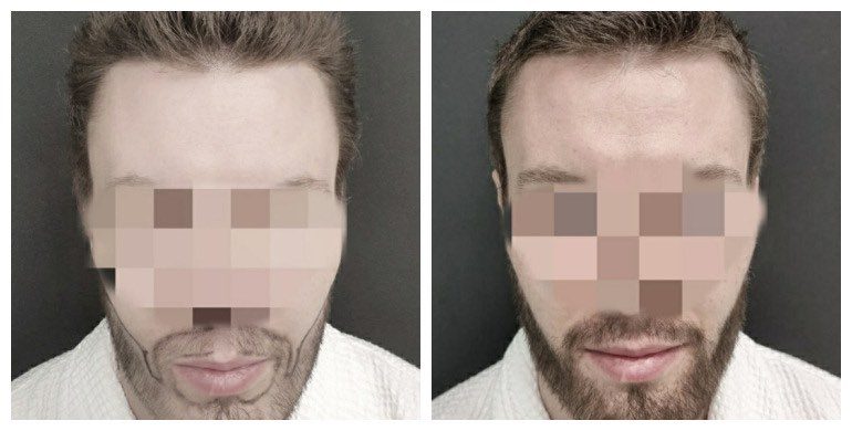 Before and after beard transplant — male