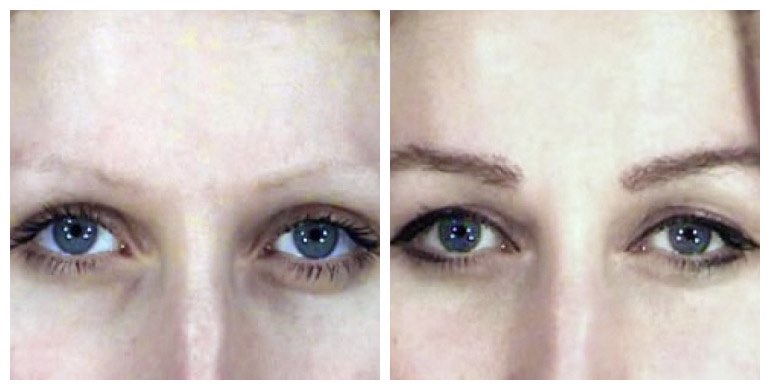 Before and after eyebrow transplant — female
