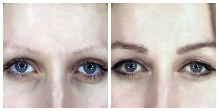 Before and after eyebrow transplant — female