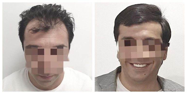 Before and after long-hair transplant (FUT) — 2,000 grafts, male