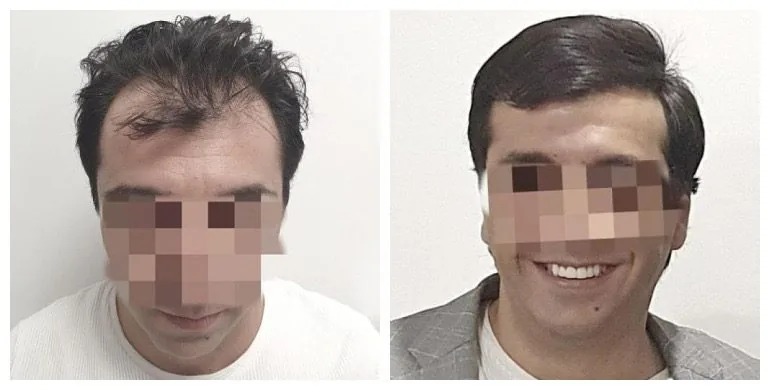 Before and after long-hair transplant (FUT) — 2,000 grafts, male