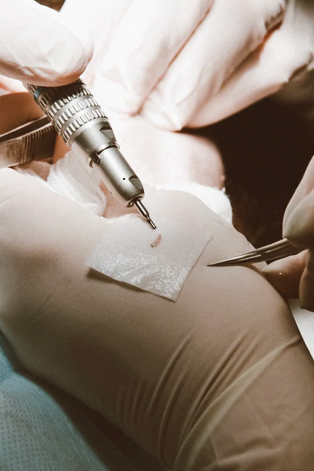 Close-up of FUE graft extraction during training