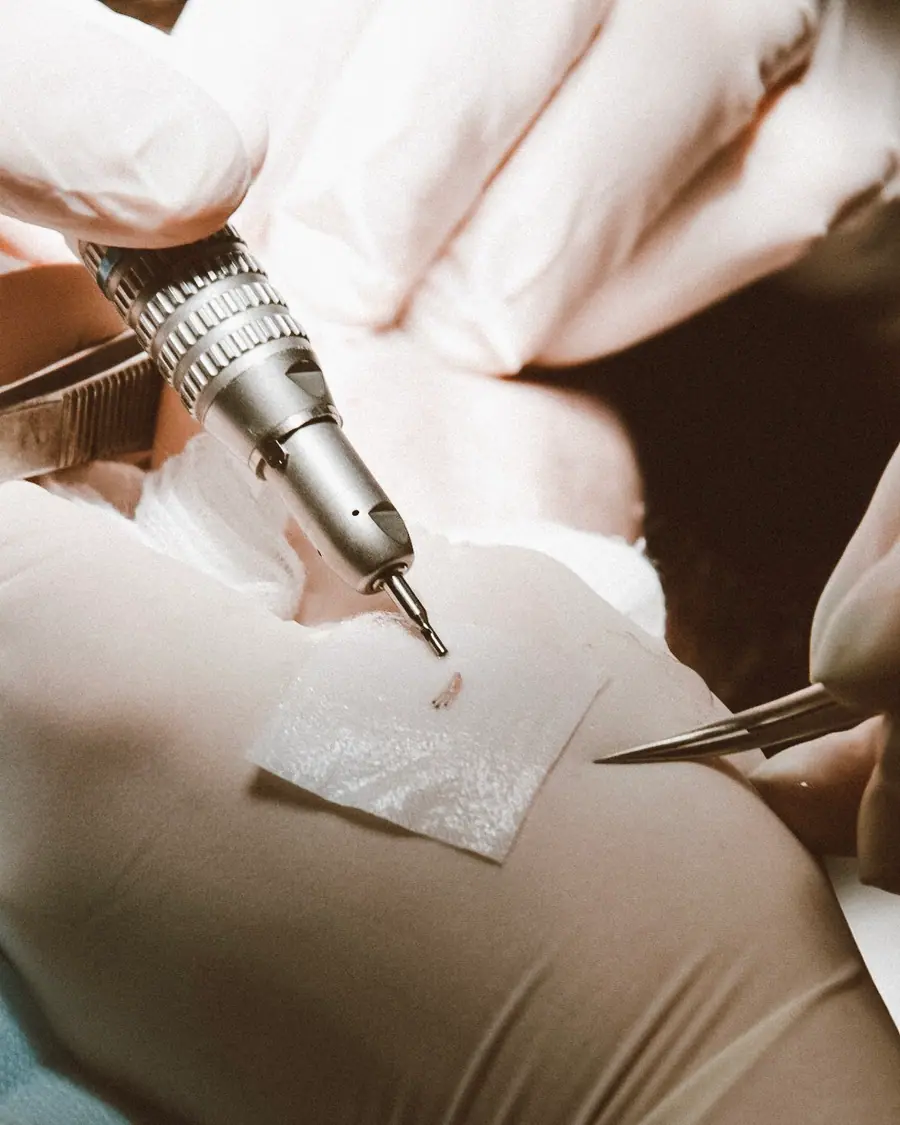 Close-up of follicular-unit graft extraction during training